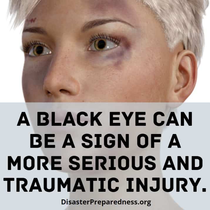 Black eyes can be signs of more serious injuries.